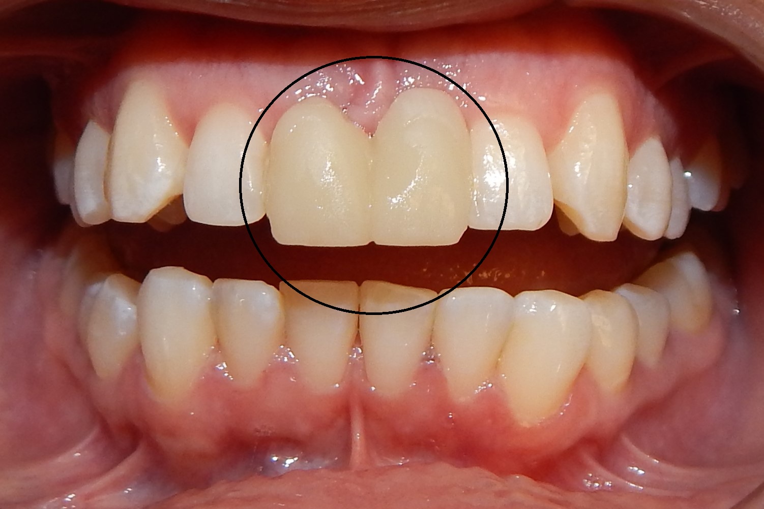 Implants & Veneers Before