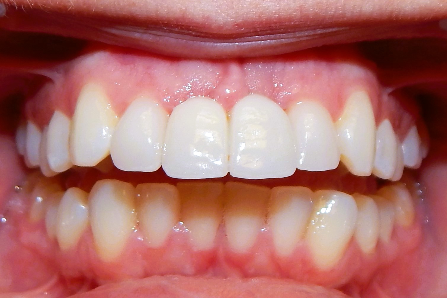 Implants & Veneers After